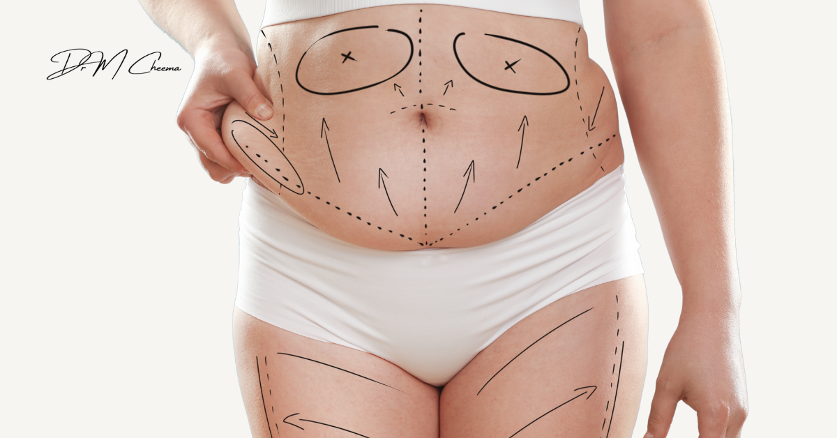 Mini Tummy Tuck vs Full Tummy Tuck