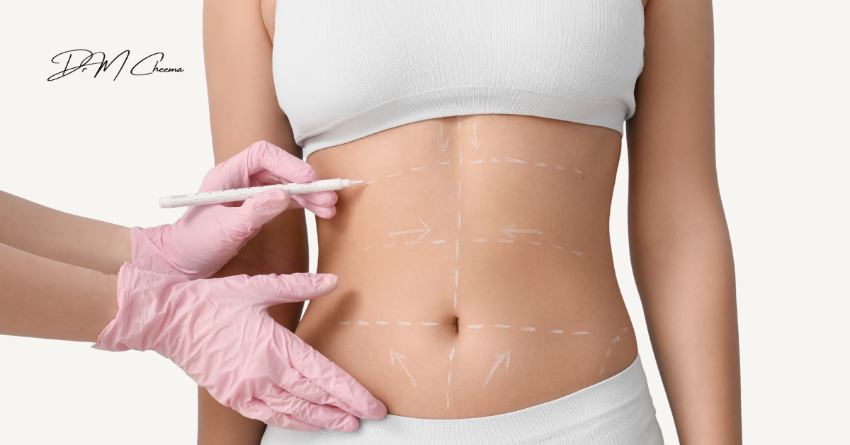 Tummy Tuck and Liposuction