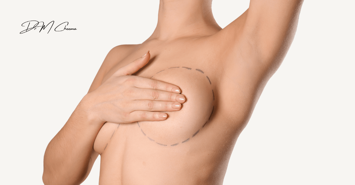 Breast Augmentation