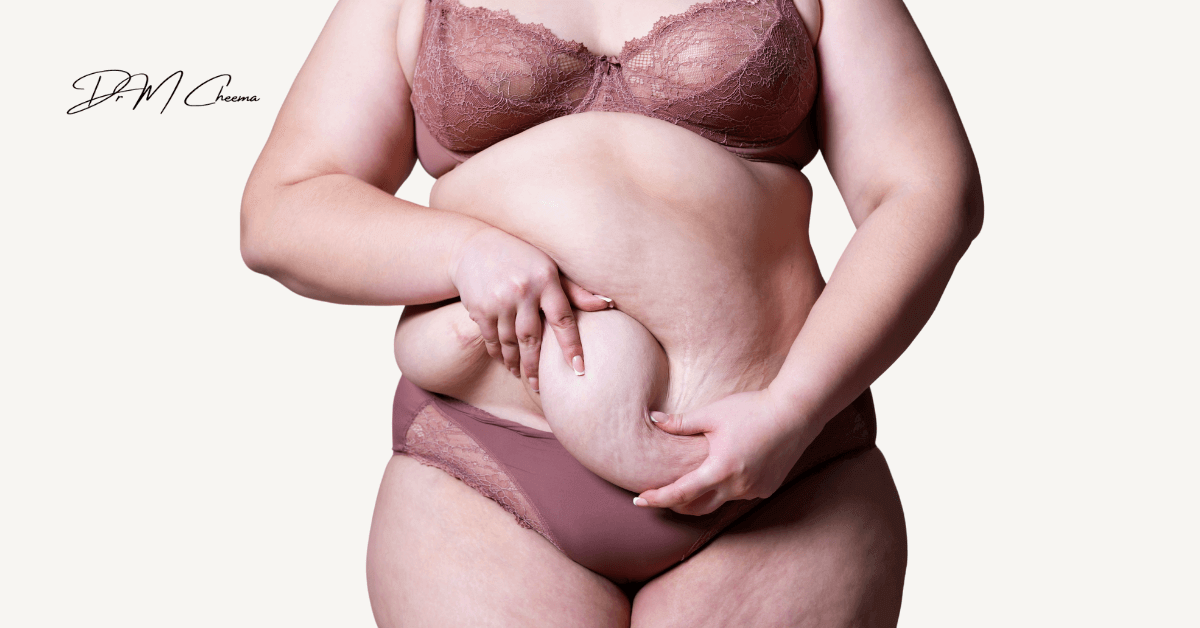Tummy Tuck vs Mini Tummy Tuck