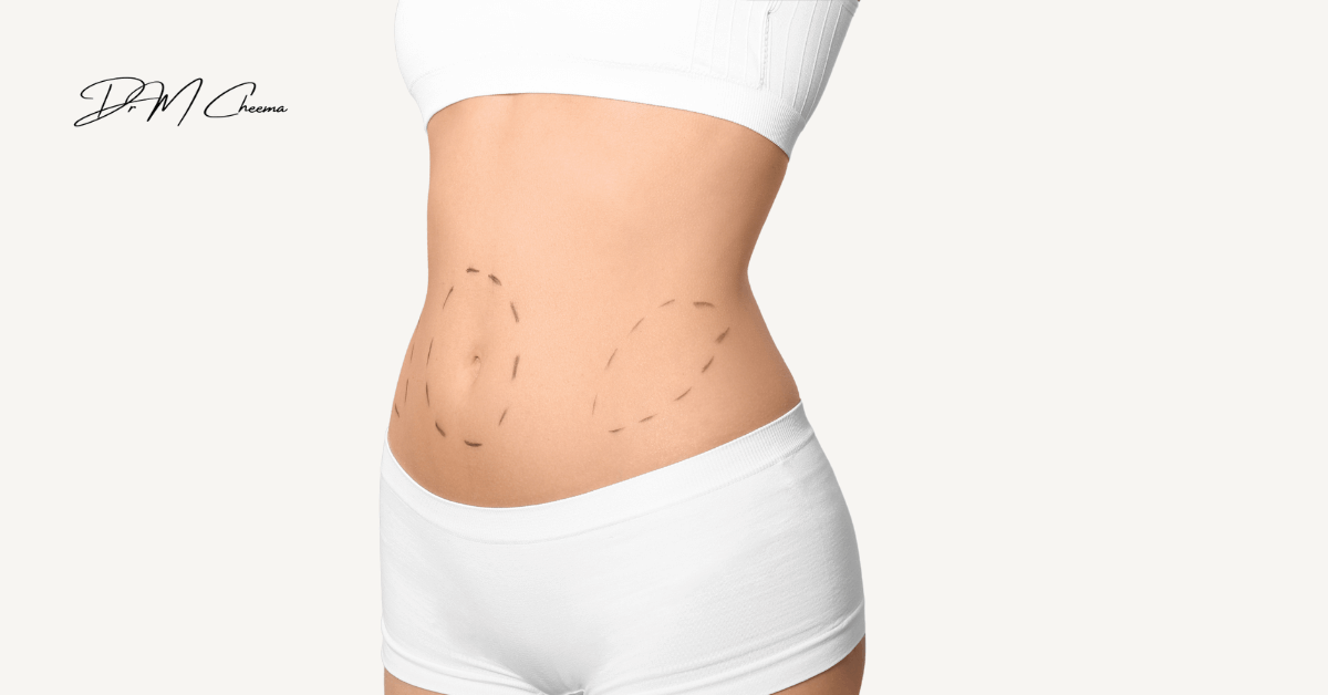 tummy trunk