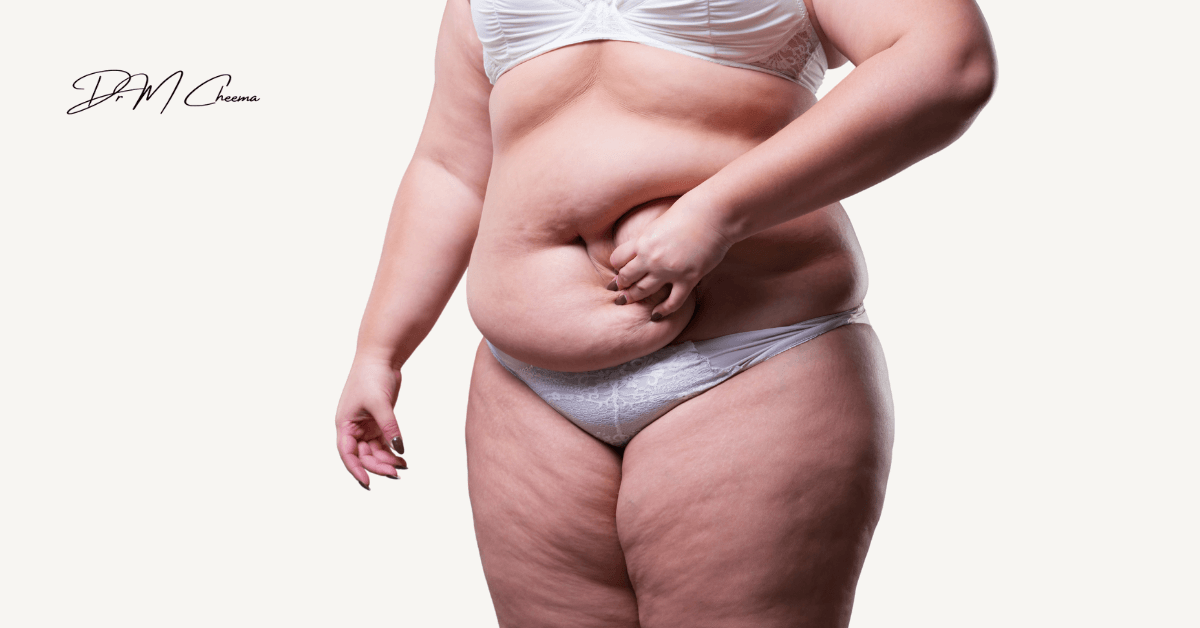 Tummy Tuck Procedure