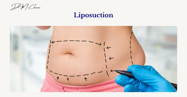 Liposuction
