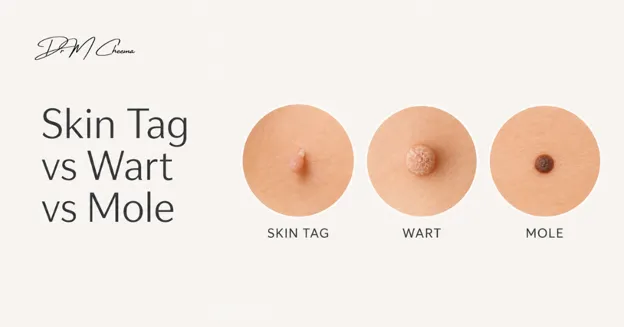 How Can You Tell a Skin Tag from a Wart or Mole