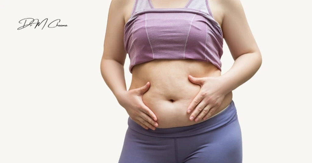 Abdominoplasty