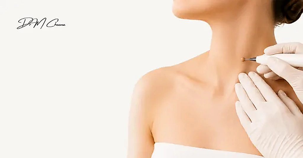 skin_tag_removal_