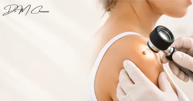 Mole Removal in Birmingham